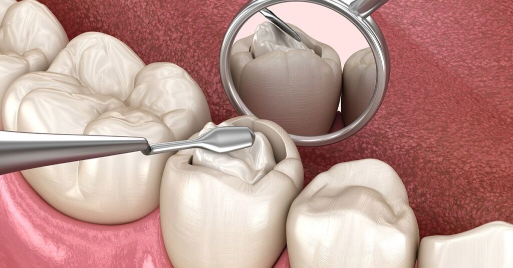 When Are Temporary Fillings Necessary