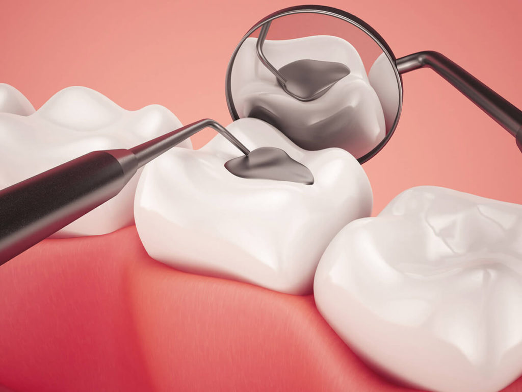 What Are The Common Mistakes To Avoid When Removing A Temporary Dental Filling