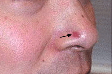 What To Do When You Have Skin Cancer On Nose