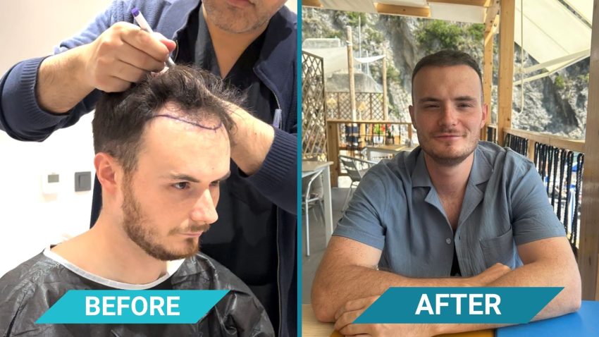 CLINIQUEPLUS Introduces Sapphire FUE Hair Transplant Method for Quicker Recovery and Precise Results